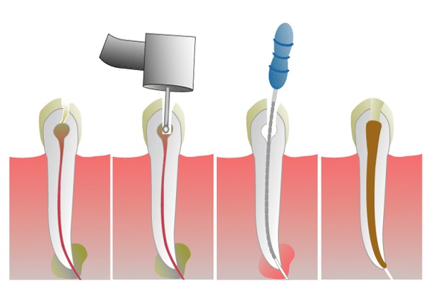 root-canal-treatment